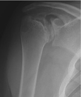 arthritic shoulder joint