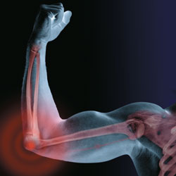 elbow surgery and hemophilia