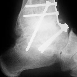 ankle surgery