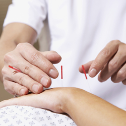 Acupuncture