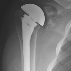 Shoulder replacement